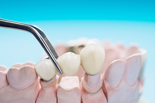 What Is a Dental Bridge?