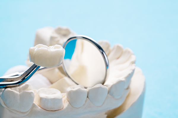 Benefits of Dental Crowns