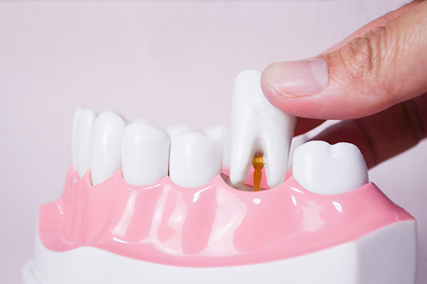 What to Expect During a Tooth Extraction