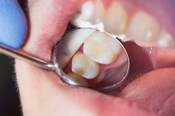 What Are Porcelain Inlays & Onlays?